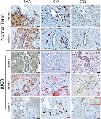 Failure of Decidualization and Maternal Immune Tolerance Underlies Uterovascular Resistance in Intra Uterine Growth Restriction